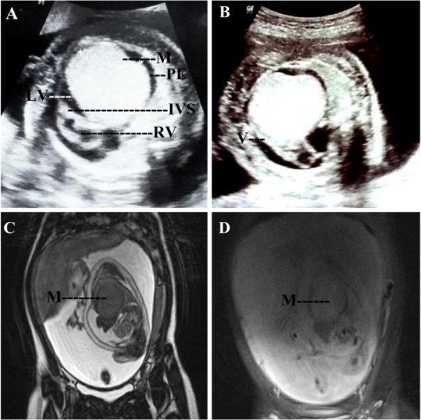Figure 2. A 23 year old primi of tuberous sclerosis with live intrauterine fetus at 26 weeks of gestation showing cardiac rhabdomyoma. A: Ultrasound in ventricular diastole showing an echogenic mass (M) arising from the wall of the left ventricle (LV