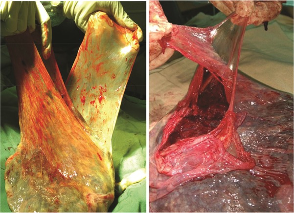 Figure 1. Peeling chorionic and amniotic membranes from each other in a placenta