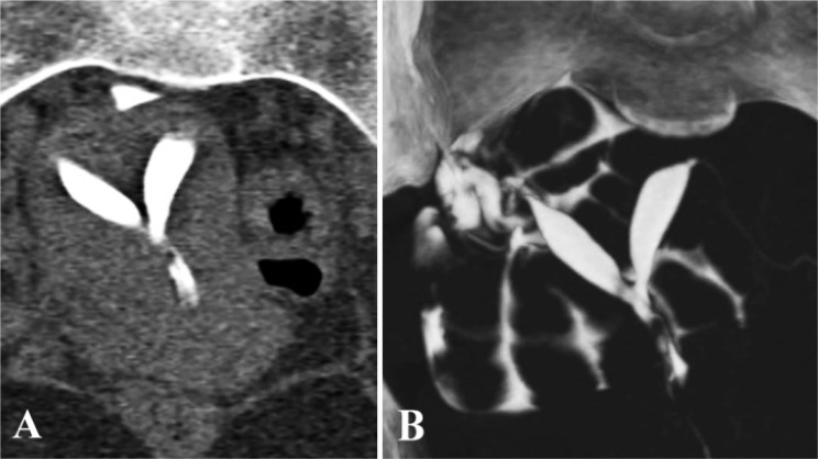 Figure 1. A: MPR coronal image shows incomplete uterine septum separating the two spindle shaped cavities, uterine fundal contour appears normal. B: MIP image showing septate uterus