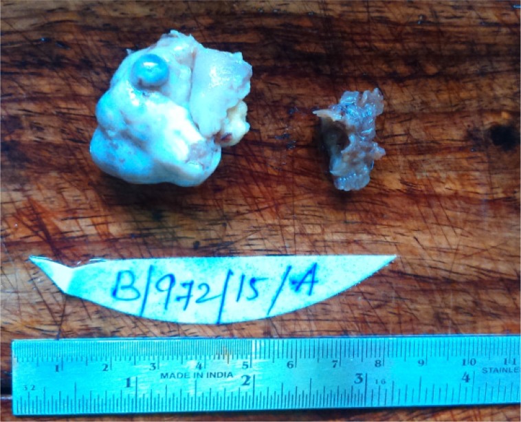 Figure 1. Nodular appearance of enlarged ovary along with a portion of fallopian tube