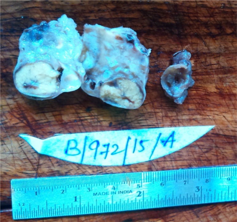 Figure 2. Cut surface showed a large yellow solid nodule