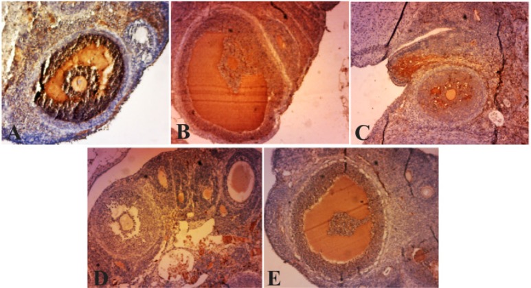 Figure 3. Photo micrographs of immunohistochemical expression of TNF-α in infolded layers and follicular fluid of Graafian follicles and cysts. A) Due to high levels of angiogenesis, the density of follicular fluid, as well as TNF-α expression are hi