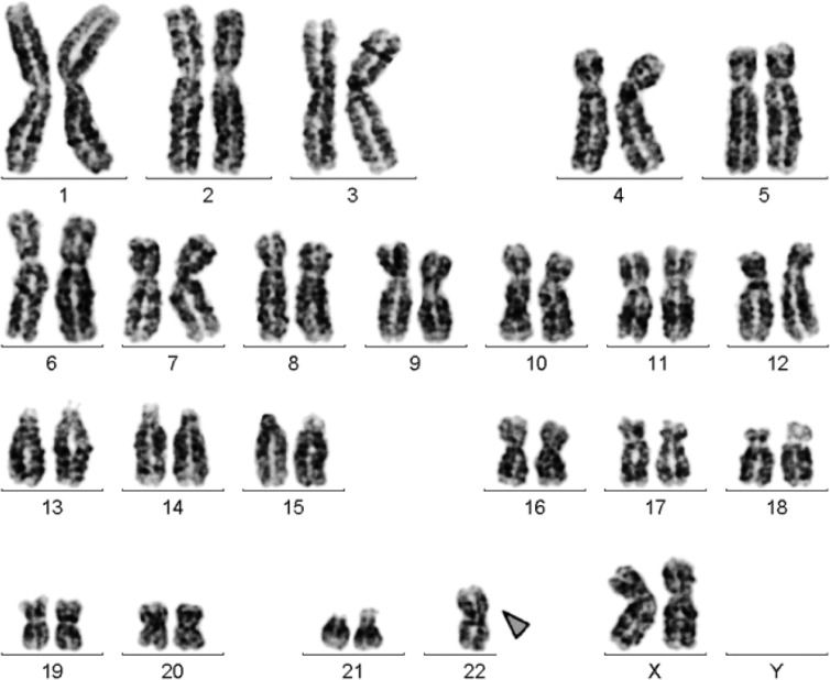 Figure 1. GTG-banding revealed a 45,XX, rob (22) (q10;q10). The derivative chromosome is marked by an arrowhead