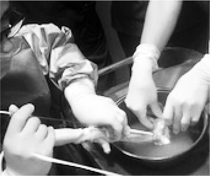 Figure 3. Follicular aspiration using vaginal ultrasound probe