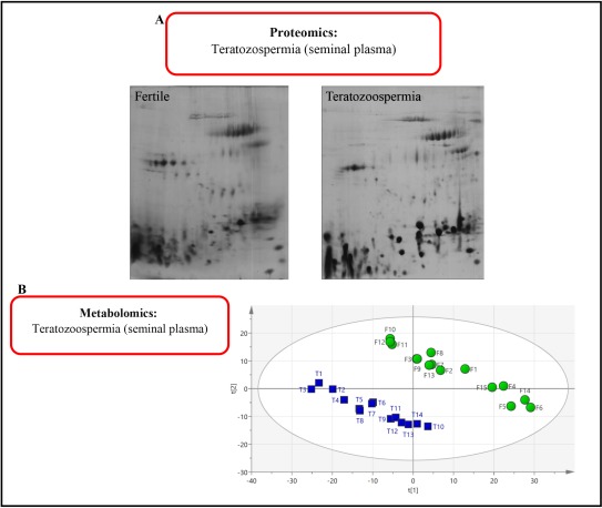 Figure 2. A: Comparison of the proteomics of seminal plasma in a fertile person and patient with teratozoospermia. B: The same metabolomics comparison. F: Fertile; T: Teratozoospermia