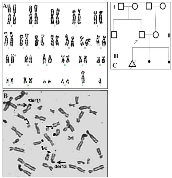 Figure 1. A: The GTG banded metaphase chromosomes of the patient showing 46,XY,13p+. B: NOR staining showing the black dots on all acrocentric chromosomes and on derivative 11q. No dots were seen on derivative 13p. C: The pedigree of the family is sh