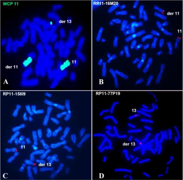 Figure 2. FISH on lymphocyte metaphase spreads of the patient. A: FISH with WCP 11 showing green signals on normal 11, derivative 11 and derivative 13 chromosomes. B: FISH with RP11-16M20 clone showing signals on normal chromosome 11 and derivative 1
