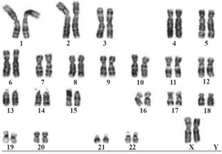 Figure 1. The Karyotype shows the patient is having two X chromosome and no Y chromosome