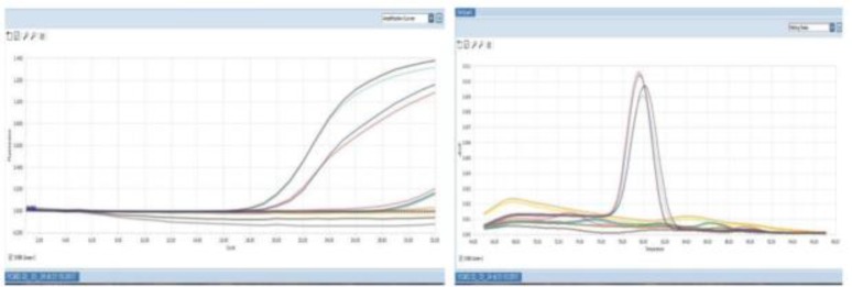 Figure 2. Real time PCR shows both amplification curve and Melt peak. No amplification of AZFa, AZFb and AZFc in test sample, but SRY and ZFX, the internal control genes show amplification