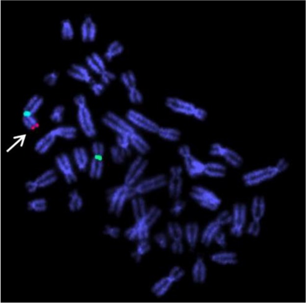 Figure 3. Dual color FISH data shows presence of two X chromosomes and SRY gene on one of the X chromosome