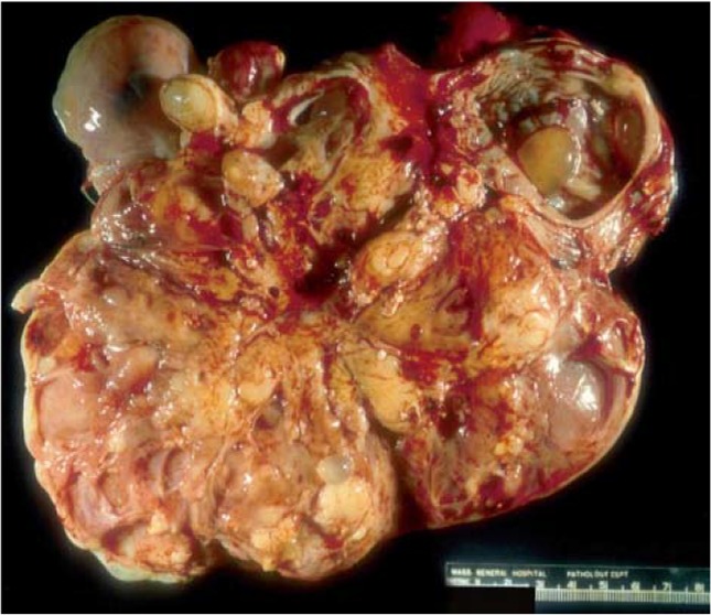 Figure 1. Gross photograph of malignant mixed germ tumor: The solid fleshy cut surface with few cysts along with areas of necrosis and haemorrhage