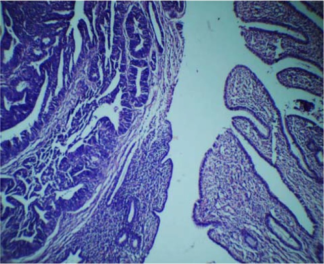 Figure 2. Photomicrograph showing malignant mixed germ cell tumor: Embryonal carcinoma mixed with immature neuroepithelium (left) and mature teratomatous component in the form of mucinous epithelium (right) (H & E, 100X)