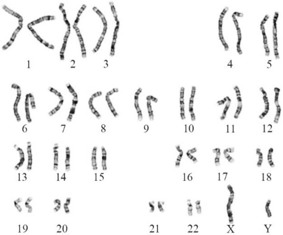 Figure 1. Karyotype image showing normal 46,XY chromosome spread in SCOS case
