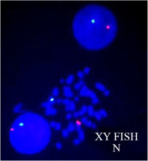 Figure 2. XY FISH image showing one green (X-centromere) and one red (Y-centromere) signal in interphase and metaphase cells of patient indicating normal (N) male sex chromosome