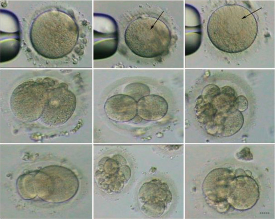 Figure 1. The morphology of oocytes and embryos derived from the infertile woman with an abnormal karyotype. Black arrows show SER cluster in the oocytes. Bar: 20 µm