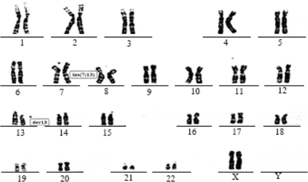 Figure 2. Karyotype analysis in an infertile woman showing a de novo insertion between chromosomes 7 and 13