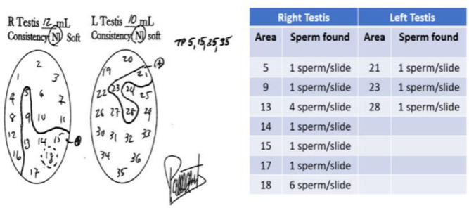 Figure 2. Result of the patient’s fine needle aspiration mapping 3 months before microTESE