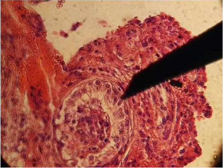 Figure 8. Testicular biopsy revealed few spermatids, along with spermatocytes