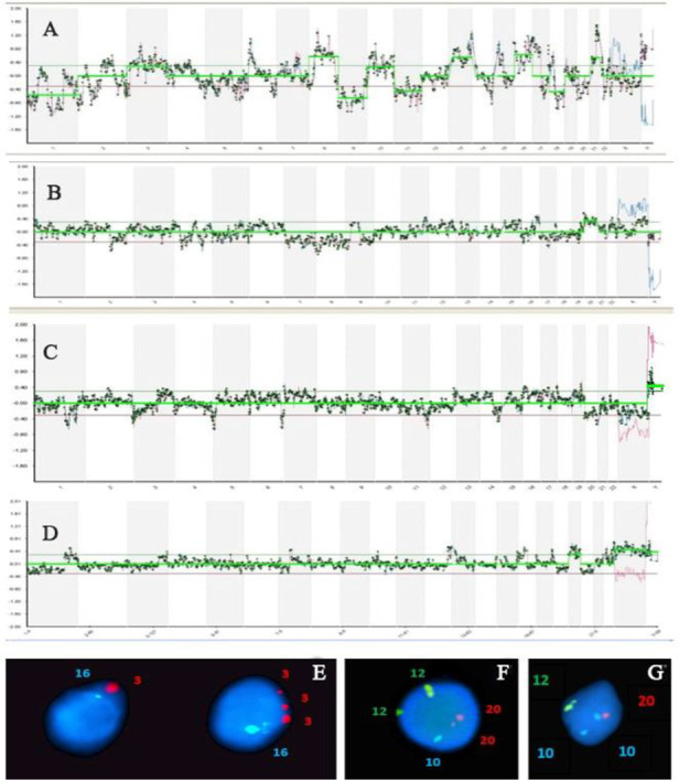 Figure 1. Array CGH profiles of OAT patients (A–D) and different types of aneuploidy in OAT sperm population as assessed by FISH (E–G). A) A genomic profile with complex abnormality for chromosomes −1+3+8–9+10–11+ 13+ 16–18+21 in patient 2. B) Single