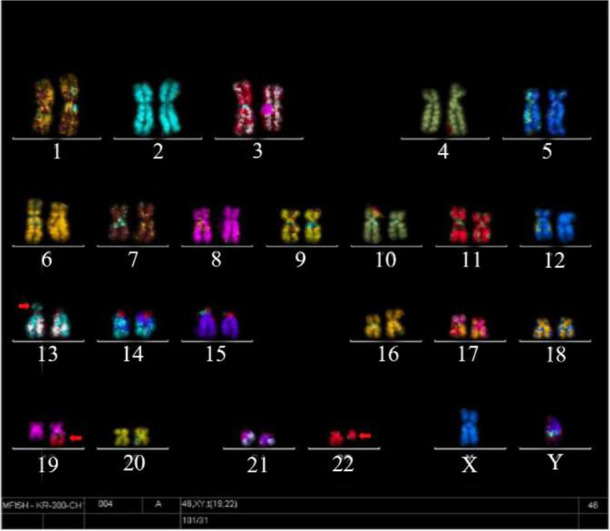 Figure 3. Multicolor fluorescence in situ hybridization (mFISH): A stable balanced chromosomal translocation in the proband, detected by mFISH. Chromosomes involved in this translocation are indicated by arrows; a balanced chromosomal translocation i
