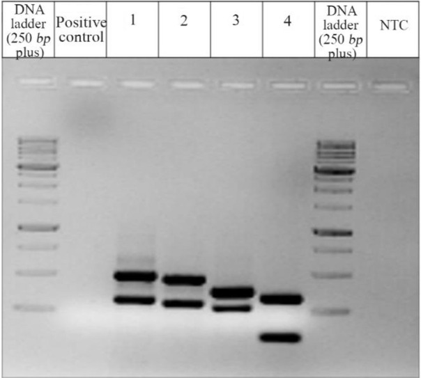 Figure 4. Y chromosome microdeletion study: 1.5% agarose gel image of the specimen for Y chromosome microdeletion analysis by PCR. Two different loci for AZFa, AZFb and AZFc along with SRY and ZFY (Control) were used for analysis along with a positiv