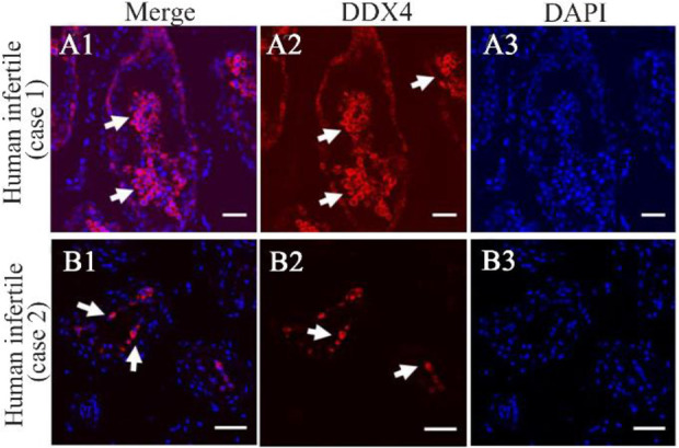 Figure 1. Immunohistochemical analysis of two abnormal human testicular tissues from infertile men. Low basal and high luminal DDX4 expression in case 1 (Merge, A1) and moderate expression in case 2 in luminal cells (Merge, B1). Dapi=blue nuclear sta