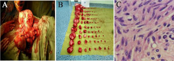 Figure 1. A) Subserosal multiple fibroids in a woman. B) Multiple fibroids (n=84) surgically removed by minimally invasive low transverse mini laparotomy. C) Transverse section leiomyoma