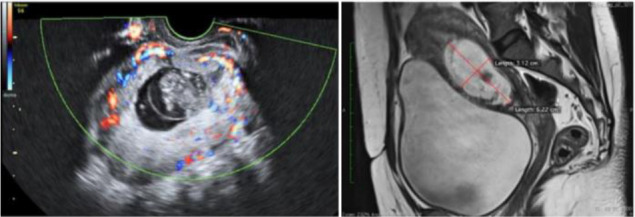 Figure 3. Color Doppler showing increased vascularity and MRI film showing anterior myometrial thickness <2 mm