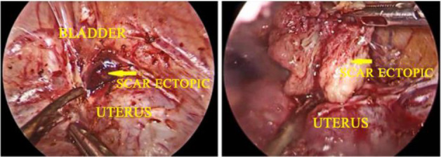 Figure 4. Laparoscopic excision of caesarean scar ectopic pregnancy