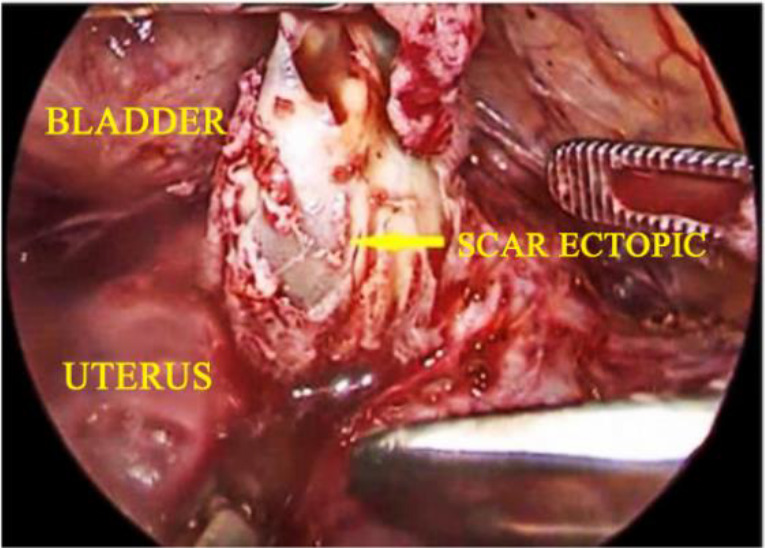 Figure 6. Laparoscopic excision of 3cm caesarean scar ectopic mass