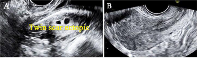Figure 8. A) Twin scar ectopic pregnancy. B) Complete resolution of scar ectopic mass on follow up scan