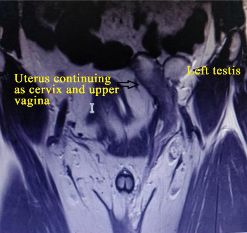 Figure 1. Pelvis coronal view by MRI showing the left testis with uterus continuing as cervix and upper vagina