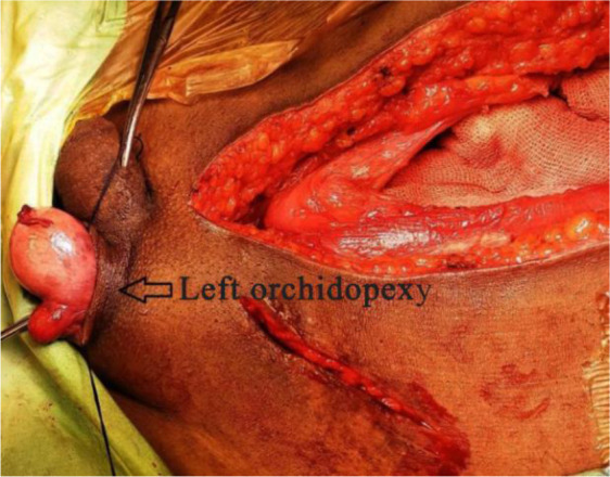 Figure 4. Intraoperative image showing left orchidopexy