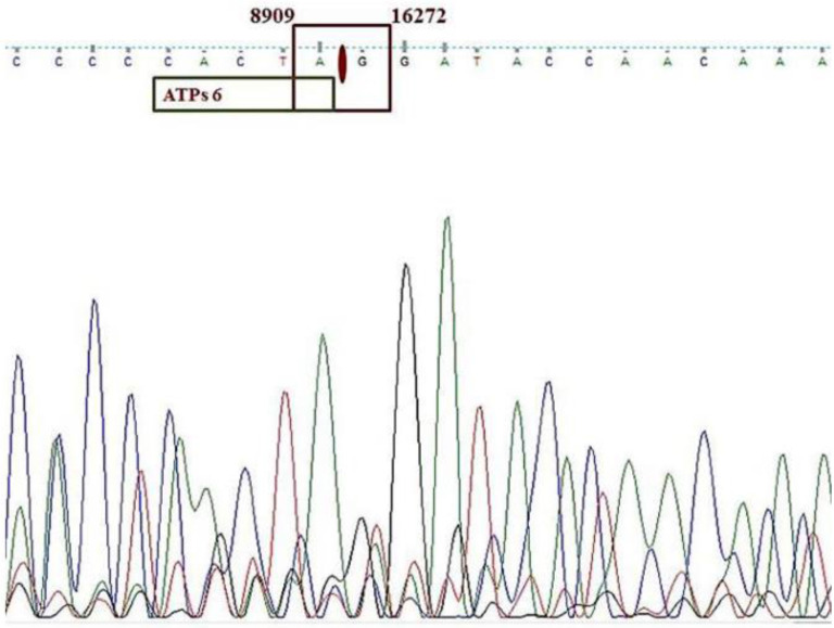 Figure 6. Sequencing result for sperm mtDNA PCR product for 7345 bp mtDNA deletion. The red arrow indicates the site of the deletion breakpoint. ATPase 6 is included within deletion