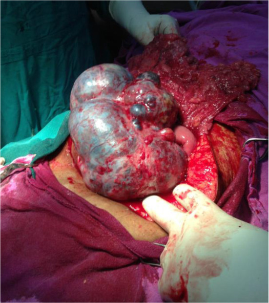 Figure 1. Gross appreance of pure malignant germ cell tumor of the ovary (endodermal sinus tumor)