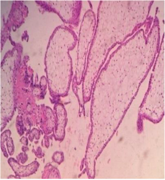 Figure 1. H&E stained section of retained products of conception