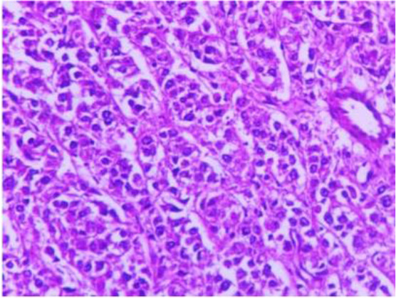 Figure 2. Larger view of multidimensional cells with clear cytoplasm, same-sized nucleus, and low atypia in dense groups