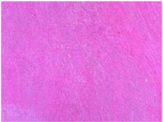 Figure 3. Neoplastic cells around vessels