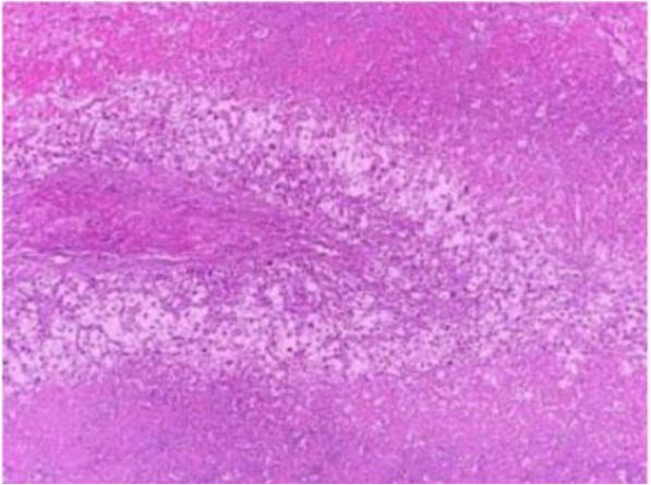 Figure 5. Immunohistochemistry with HBM45 marker