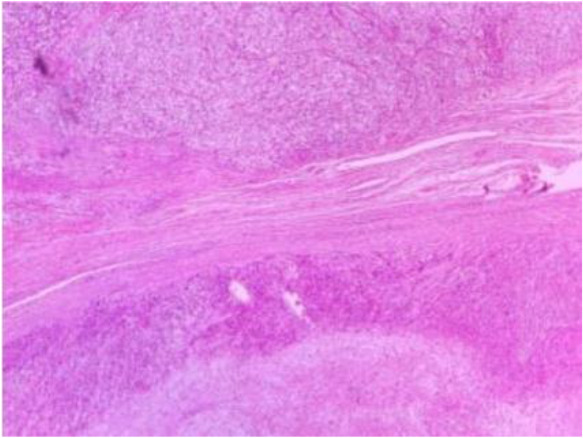 Figure 6. Immunohistochemistry with Melan A marker