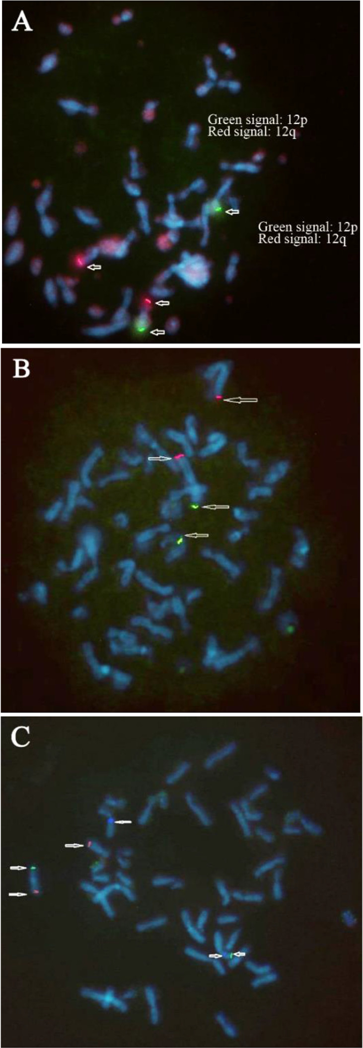 Figure 4. FISH images: A) Metaphase FISH showing 12p (green) signal on 2p (green signal: 12p, red signal: 12q), B) Metaphase FISH showing 2p (green) signal on 6p (green signal: 12p, red signal: 2q), C) Metaphase FISH showing 6p (green) signal on 12p