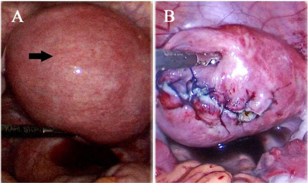 Figure 4. A) Laproscopic view showing a large fibroid in the left posterolateral wall of uterus (black arrow). B) Laparoscopic view showing stitched uterus following myomectomy