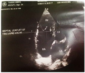 Figure 1. The lesion of tricuspid regurgitation with a small right ventricle