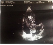 Figure 2. The ECHO findings of the patient. The findings are suggestive of severe tricuspid regurgitation