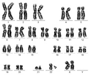 Figure 1. GTG-banding revealed a 45,XX, rob (22) (q10;q10). The derivative chromosome is marked by an arrowhead
