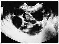 Figure 1. Transvaginal ultrasound image of the ovary before stimulation