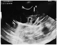 Figure 4. Ultrasound image during guided needle follicular aspiration