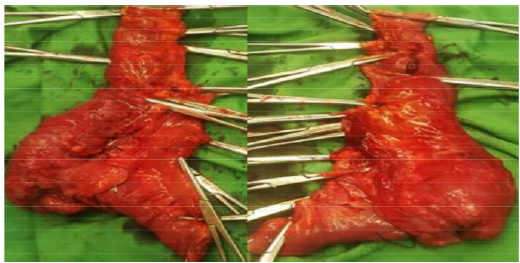 Figure 1. Postoperative specimen of the bowel. The mass is visible at cecum segment