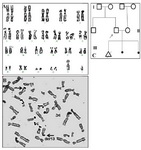 Figure 1. A: The GTG banded metaphase chromosomes of the patient showing 46,XY,13p+.&nbsp; B: NOR staining showing the black dots on all acrocentric chromosomes and on derivative 11q. No dots were seen on derivative 13p. C: The pedigree of the family is shown