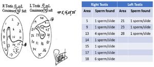 Figure 2. Result of the patient&rsquo;s fine needle aspiration mapping 3 months before microTESE